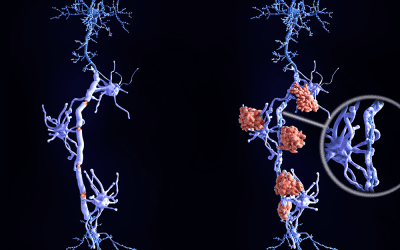 Innovative Strategies Address Risks Related to Multiple Sclerosis Treatments