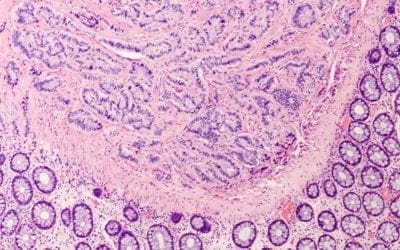 Innovative therapies clinical plan requires understanding Why Immune Cells Extrude Webs of DNA and Protein