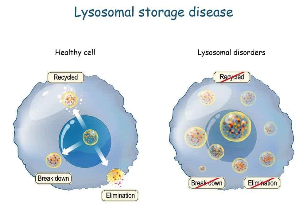Cell and gene advanced therapy in the Battle for Lysosomal Storage Disease
