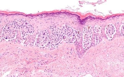 The Effect of Fecal Transplant on Melanoma